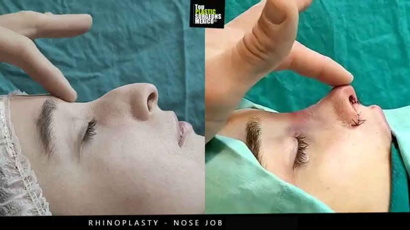 Nose Job - Rhinoplasty in Mexico - TopPlasticSurgeonsMexico 7
